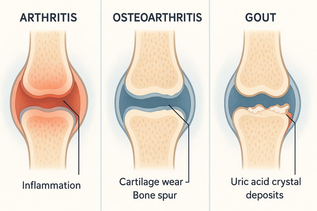 Arthritis, osteoarthritis, gout